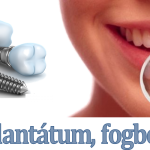Fog implantátum A-Z ig